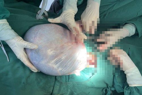 Phẫu thuật cắt khối u buồng trứng nặng gần 9kg cho bé gái 15 tuổi