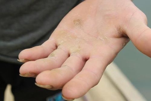 Bí quyết làm mờ vết chai tay, chai chân giúp da mềm mại ngay tức khắc