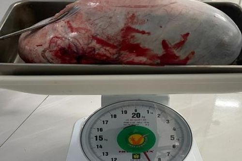 Bé gái 15 tuổi mang trong mình khối u nang buồng trứng 'khủng' nặng 9kg