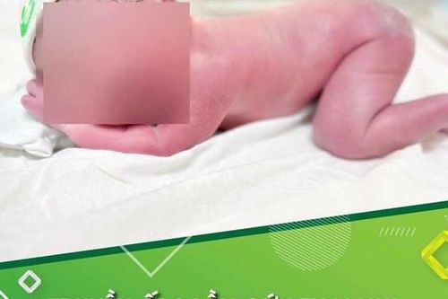 Phát hiện thai nhi cạn ối, nằm co như bị hút chân không