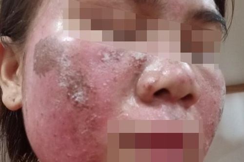 Sau hai tuần bôi kem peel da mua trên mạng, cô gái 26 tuổi hoảng hốt tìm bác sĩ