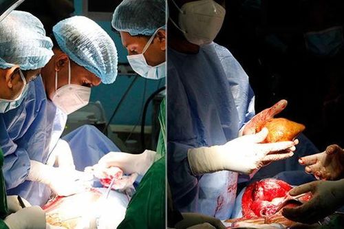 Sri Lanka: Phẫu thuật loại bỏ viên sỏi thận lớn nhất thế giới