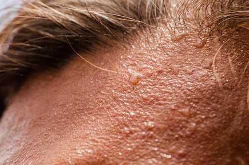 6 hiểu lầm phổ biến về chứng tăng tiết mồ hôi