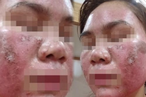 Mặt bỏng rát, bong tróc như da rắn sau khi bôi thuốc tại spa
