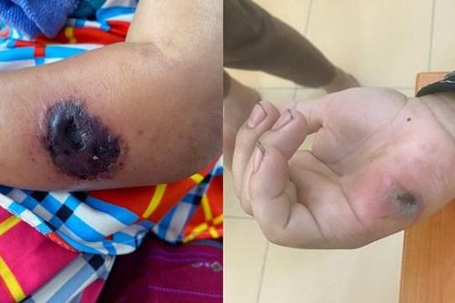 Phòng tránh sự nguy hiểm của bệnh than ra sao?