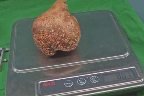 Mổ lấy thành công viên sỏi thận nặng 800 gram to nhất thế giới