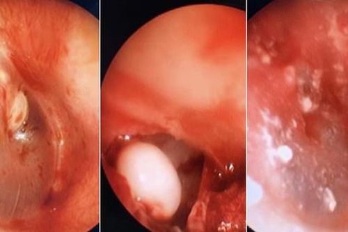 Tìm thấy 'hạt ngọc trai' trong tai bé 5 tuổi do mắc bệnh hiếm gặp