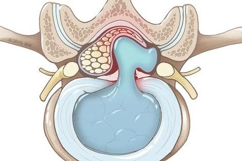 Thoát vị đĩa đệm có thể gây ra những biến chứng nguy hiểm nào?