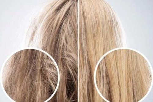 Tóc rụng, mỏng và cách xử trí