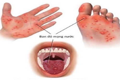 Bệnh tay chân miệng ở TP HCM tăng mạnh