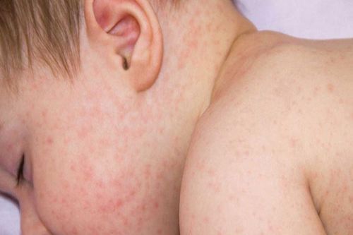 Dị ứng thời tiết ở trẻ em: Chăm sóc trẻ thế nào là đúng cách?