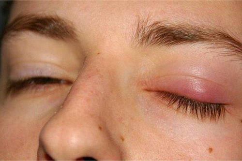 Lựa chọn các thuốc điều trị bệnh chắp mắt