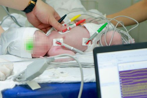 Cứu trẻ mắc tim bẩm sinh nặng ngay từ khi chào đời