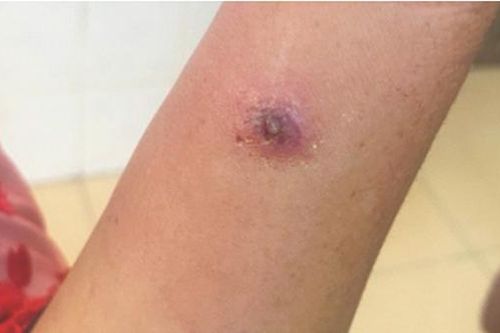 Bệnh than - mối hiểm họa tiềm ẩn lâu dài