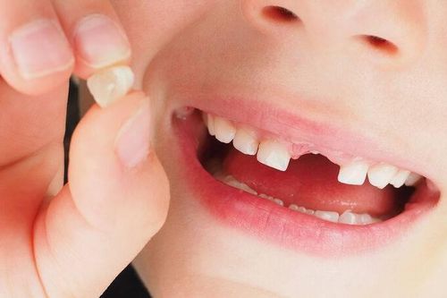 Sơ cứu răng rơi khỏi ổ đúng cách khi gặp tai nạn chấn thương răng