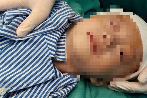 Ngã từ độ cao 2m, bé trai 20 tháng bị lún sọ