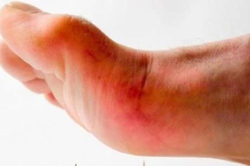 Nam thanh niên suýt chết vì vết thương rất nhỏ ở bàn chân
