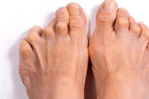 Viêm khớp dạng thấp có thể gây nhầm lẫn với bệnh nào?