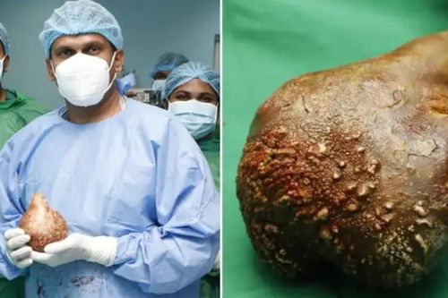 Phẫu thuật loại bỏ viên sỏi thận lớn nhất, nặng nhất thế giới ở Sri Lanka