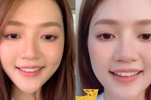 An Vy chia sẻ bị liệt dây thần kinh một bên mặt, cười nói khó khăn