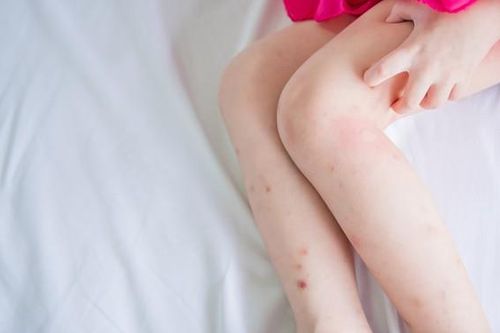Nên làm gì để loại bỏ các vết thâm do côn trùng cắn?