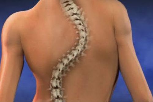 Cẩn trọng với bệnh cong vẹo cột sống