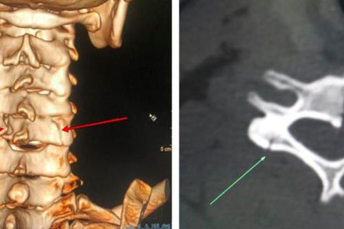 Một tháng, 10 người vào viện cấp cứu khi trèo cây hái vải