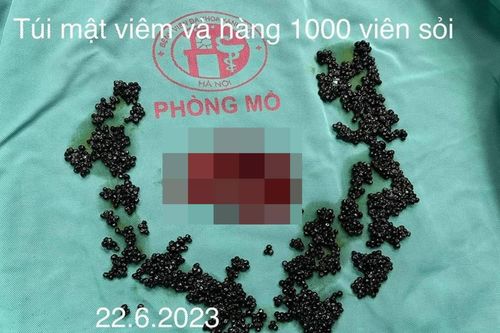 Phẫu thuật lấy hàng nghìn viên sỏi trong túi mật cụ bà 73 tuổi