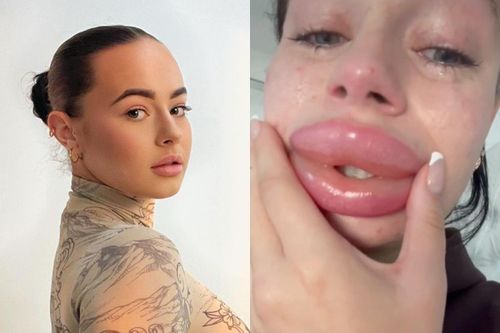 Cô gái Mỹ bị biến dạng môi vì lời mời tiêm filler miễn phí