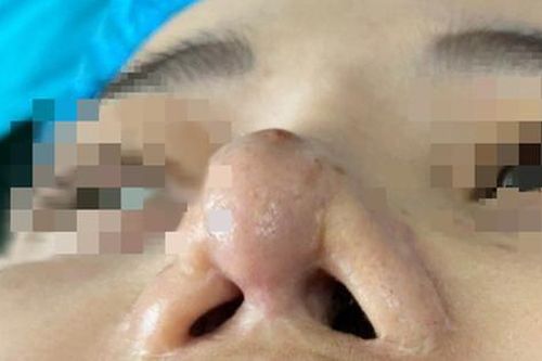 Chủ cơ sở làm đẹp bị biến dạng mũi sau 9 lần 'sửa chữa' trong 10 năm