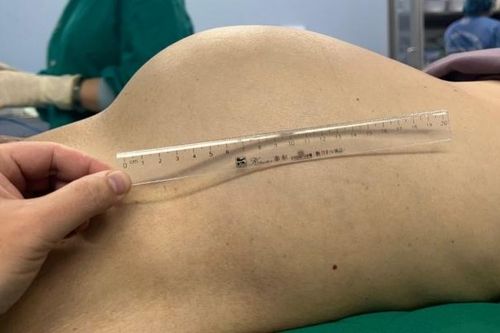 Nội tạng bị biến dạng do khối u nặng 5,5kg 'bao trùm' chèn ép