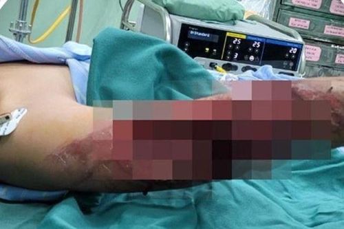 Bé 7 tuổi ngã gãy tay do áo chống nắng cuốn vào xích xe máy