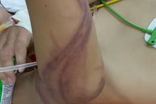 Tắm biển nếu bị sứa đốt thì làm ngay điều này để phòng nguy hiểm