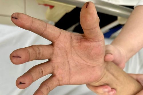 Bé trai 10 tuổi tử vong do bị dùng dao lam rạch chảy máu để thải độc chữa bệnh