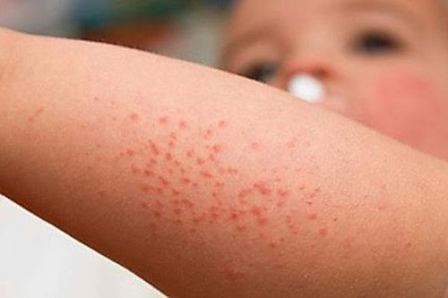 Sốt xuất huyết 'vào mùa' sớm