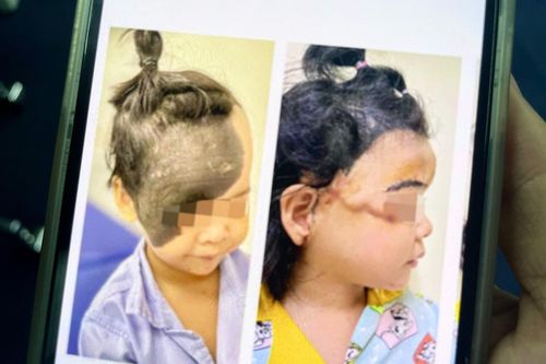 Khối u đen sạm khổng lồ chiếm nửa khuôn mặt bé gái