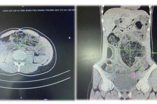 Một người đi cấp cứu vì ăn mít, cảnh báo tắc ruột do bã thức ăn