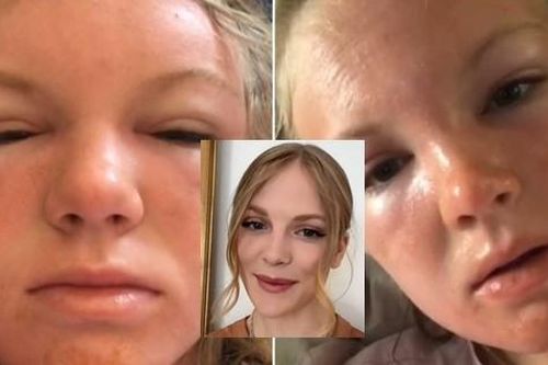 Cô gái mặt sưng vù chỉ vì làm điều này dưới nắng