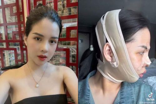 Chi nửa tỷ chỉnh sửa nhan sắc, gái xinh Quảng Ninh 'lột xác' thành công