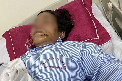 Nhắc nhở hàng xóm thả chó làm mất vệ sinh, người phụ nữ bị đánh nhập viện
