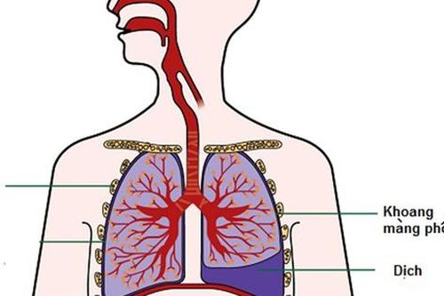 Tràn dịch màng phổi: Nguyên nhân, biểu hiện và điều trị