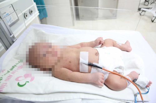 Nuôi sống bé sinh non nặng 700 g