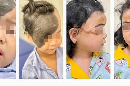 Hành trình gian nan nhận lại trái ngọt của bé gái có khối u hắc tố khổng lồ trên mặt