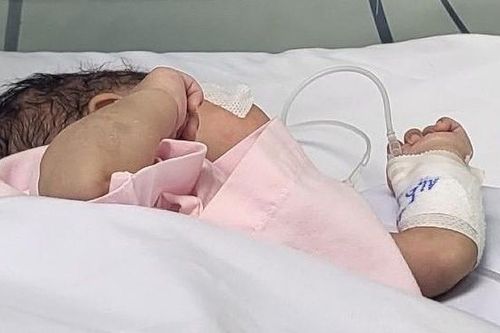 Bác sĩ căng não với khối bướu máu phủ kín 1/3 cơ thể bé sơ sinh