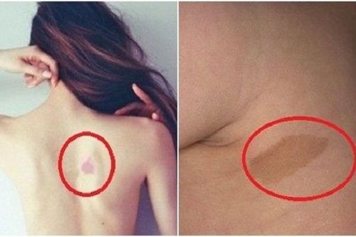 Vết bớt trên cơ thể là điềm báo tốt hay xấu?