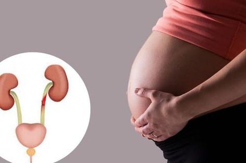Nhận biết dấu hiệu viêm đường tiết niệu ở mẹ bầu để điều trị sớm, ngừa biến chứng