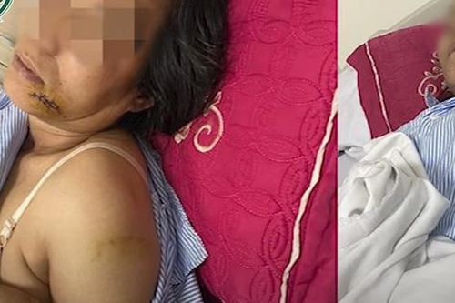 Bị đánh nhập viện vì nhắc hàng xóm nuôi chó làm 'Mất vệ sinh'