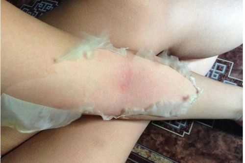 Nguy cơ ung thư da từ trào lưu lột trắng da cấp tốc