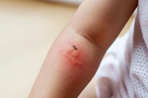Nhận biết dấu hiệu điển hình do côn trùng đốt