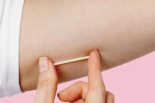 Cẩn trọng với que cấy tránh thai bị nghi là hàng giả